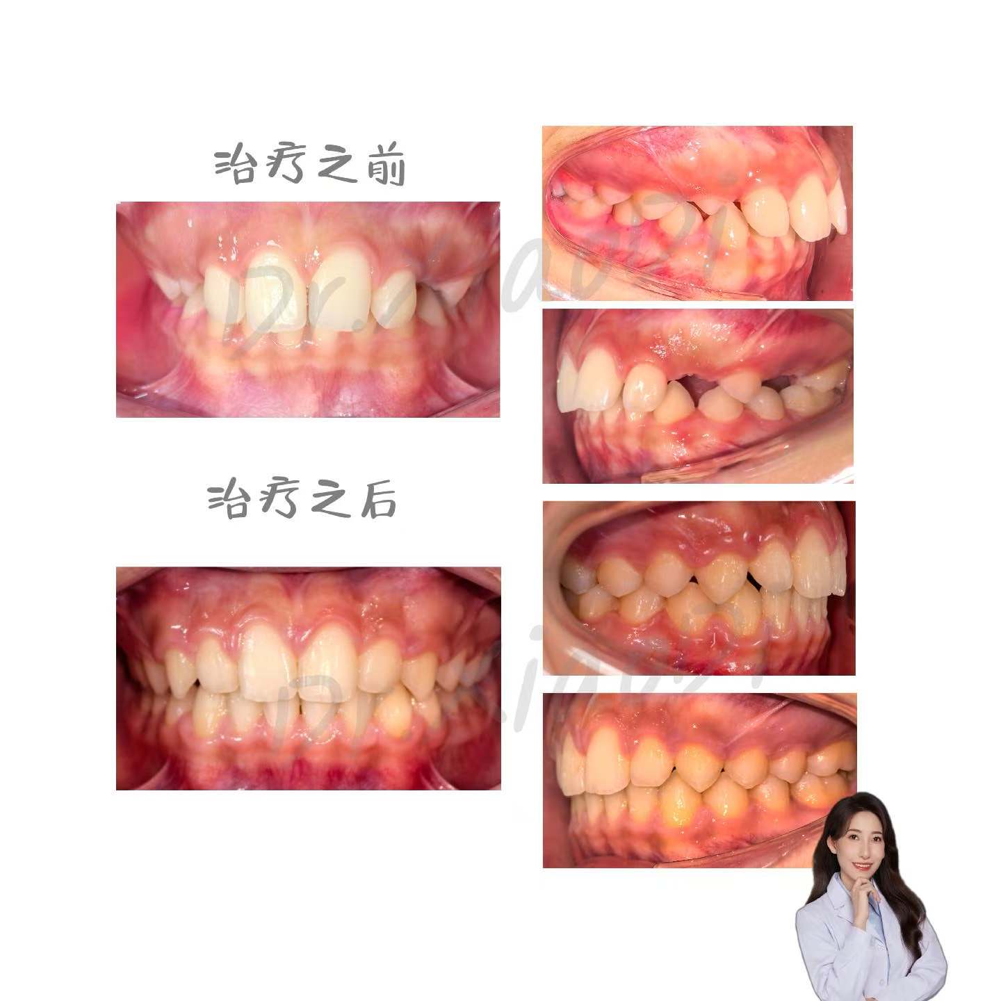 牙齿矫正案例